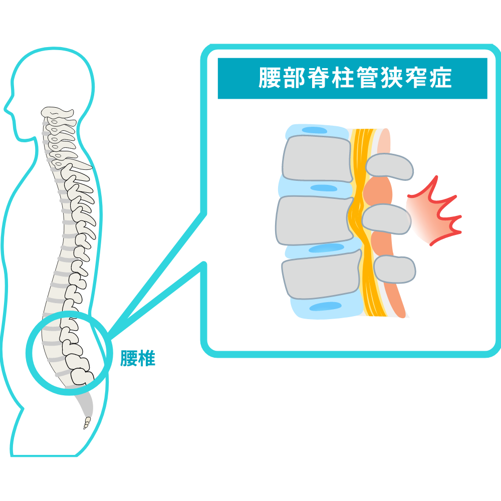 脊柱管狭窄症